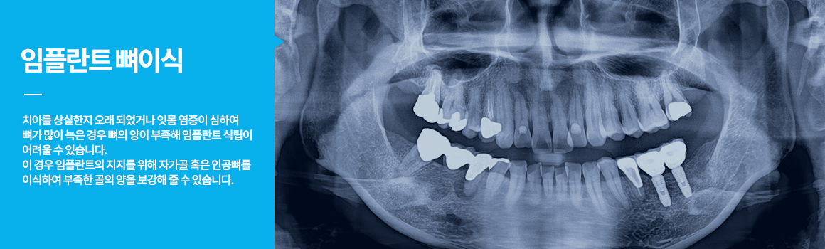 평균적인 성인의 치아개수는 약 28~32개로 치아가 필요한 제 기능을 다하기 위해서는 결손 된 치아 없이 모든 치아가 제 자리에 있어야 합니다. 하지만 예기치 못한 사고나 심한 치주질환 등으로 치아를 상실하게 되는 경우도 있는데, 이때 이를 방치하게 되면 빠진 치아의 자리에 치아와 맞물리는 치아가 아래로 내려오거나 도미노처럼 주변의 치아들이 빈 치아 공간으로 쓰러지는 현상이 나타나 전반적으로 치아의 간격이 넓어질 수 있어 치아의 탈락이 이루어진 자리에는 새로운 대체 치아를 식립하는 것이 바람직합니다. 
씹는 즐거움 선물!! 치주질환이나 사고 등으로 인해 상실된 자아의 자리에 인체에 무해하면서도 부작용이 없는 티타늄으로 제작된 본체를 심고, 그 위에 내 자연 치와 유사한 보철물을 씌워 본래의 내 치아와 같은 기능을 회복시켜 주는 치료입니다. 자연치아는 최대한 살리고, 꼭 필요한 만큼의 최소 임플란트 식립 원칙!
