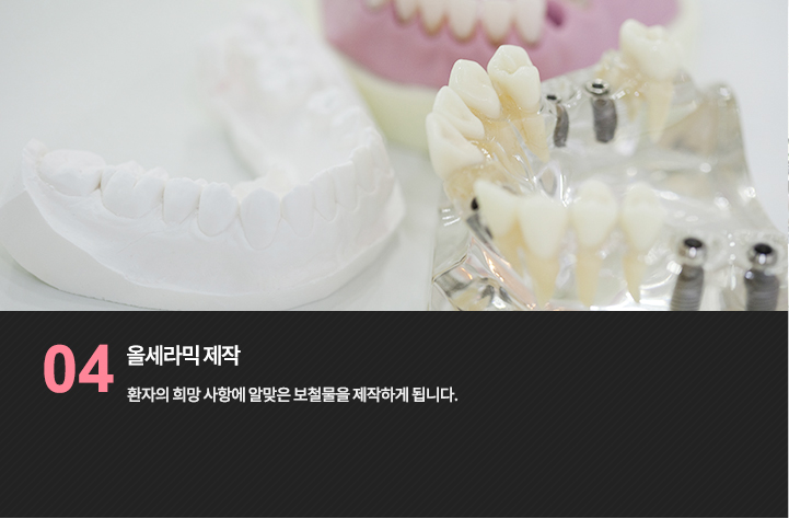 보철 제작 모형 참고 사진