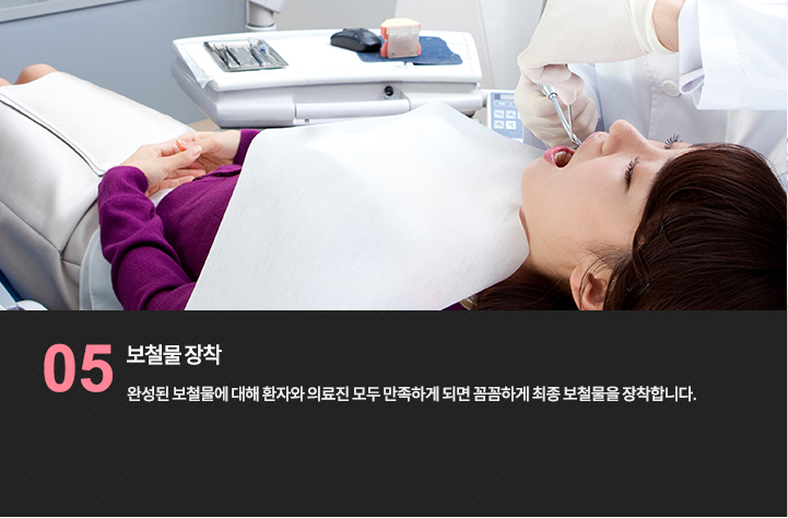 보철 장착 진료 참고 사진