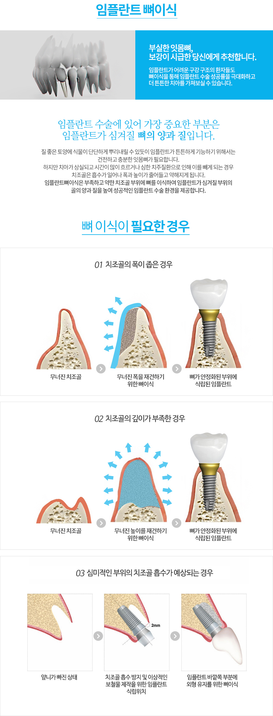 잇몸뼈의 폭이 좁은 경우: 부족한 뼈를 보완하고 임플란트를 식립하는 개념도