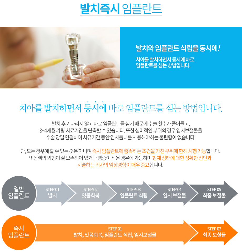 임플란트 구조를 설명하는 모형
