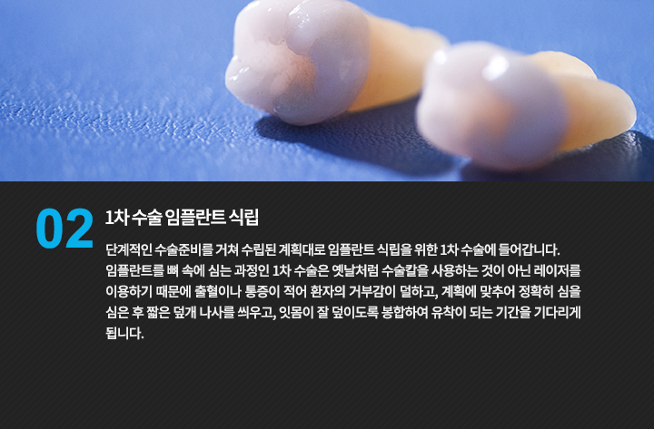 임플란트와 보철물 모형