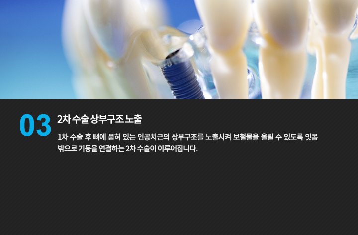 인공치근과 상부 보철물의 연결 모형