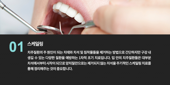 구강 검사와 치석 제거를 설명하는 사진