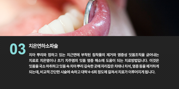 잇몸 아래 부위의 기구 치료를 설명하는 사진
