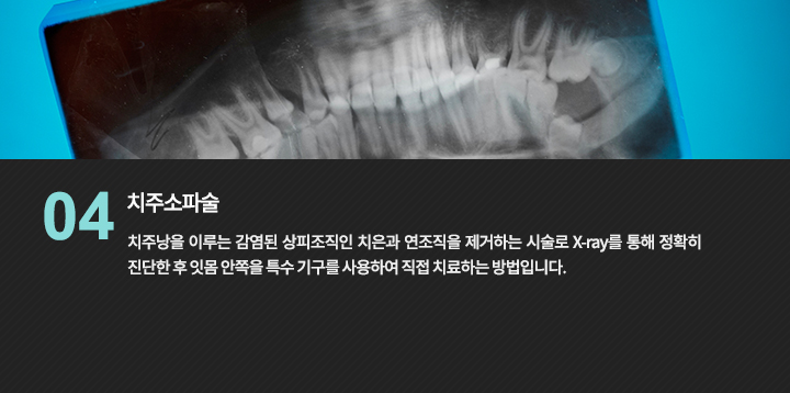 치주 진단에 활용되는 치아 영상의 참고 사진