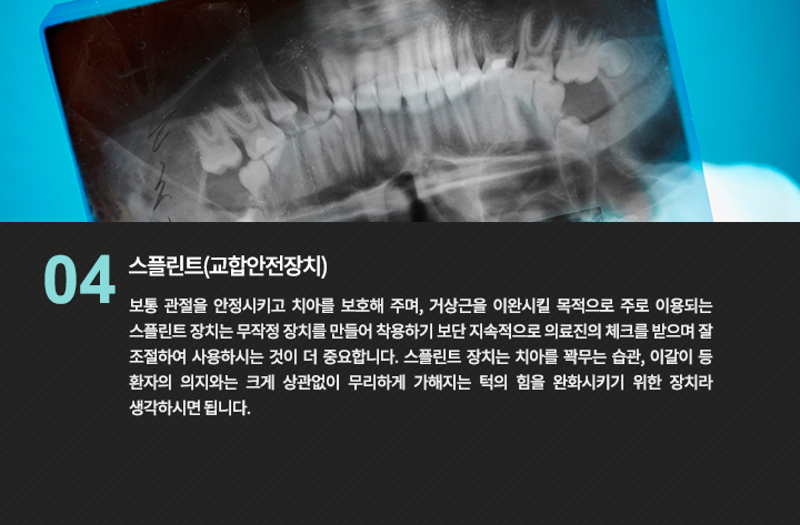 치아와 턱뼈가 보이는 방사선 영상