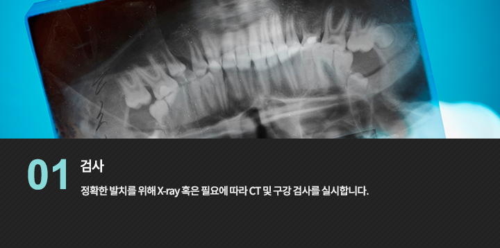 치아 X-ray 참고 사진